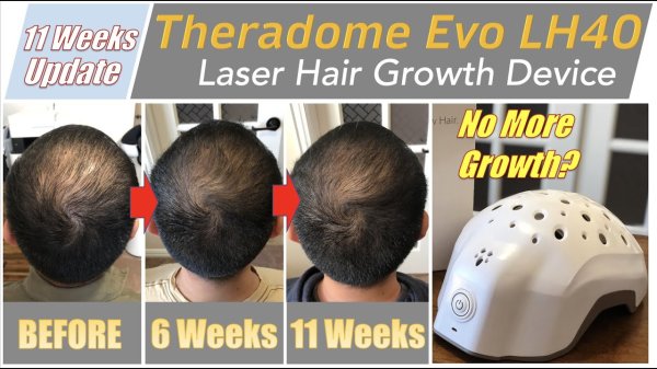 画像4: セラドーム ヘルメット型 低出力レーザー器 Theradome EVO LH40 Laser Hair Growth Device (4)
